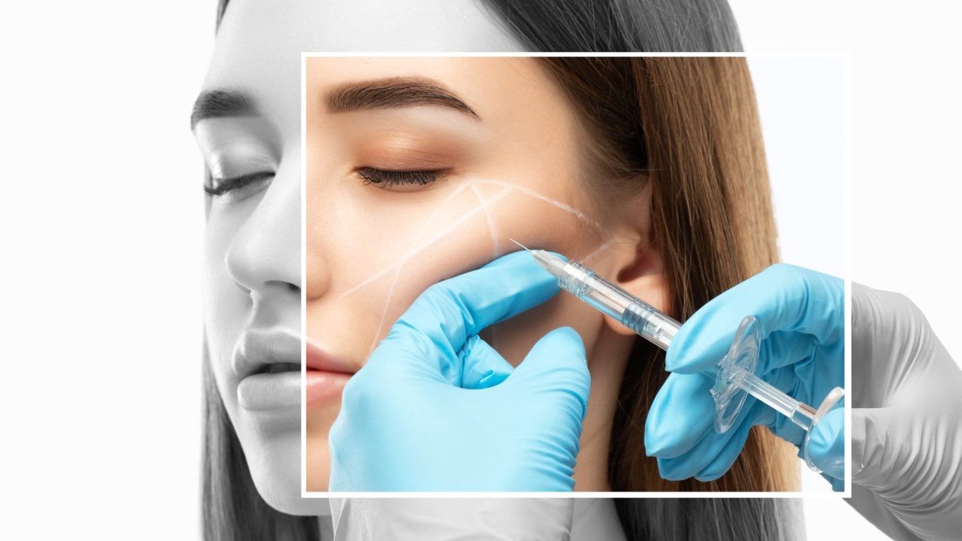 Biolifting Behandlung bei AMF Aesthetic Medical Fusion in Reutlingen