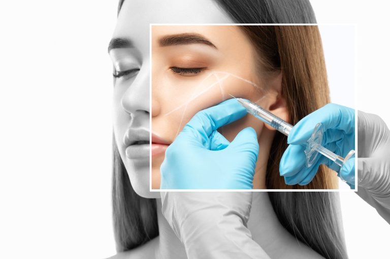 Biolifting Behandlung bei AMF Aesthetic Medical Fusion in Reutlingen