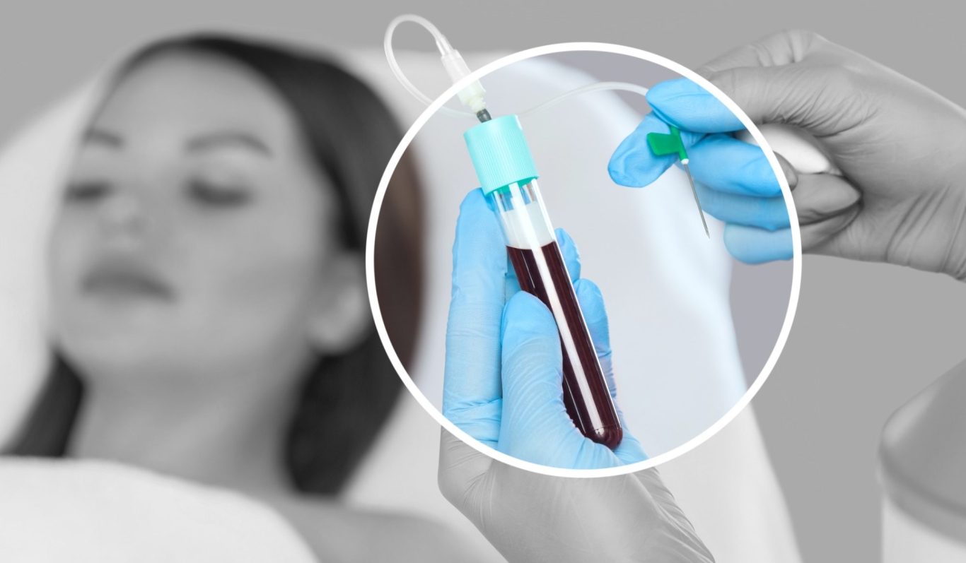 PRP (D4) Behandlung bei AMF Aesthetic Medical Fusion in Reutlingen