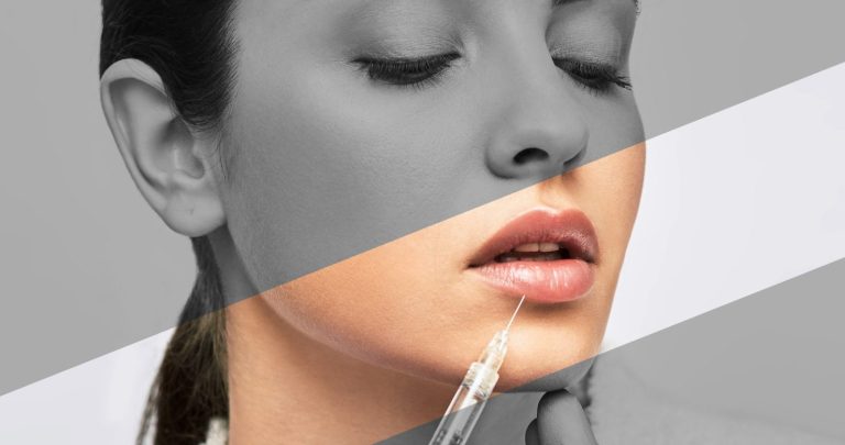 Hyaluron Behandlung bei AMF Aesthetic Medical Fusion in Reutlingen