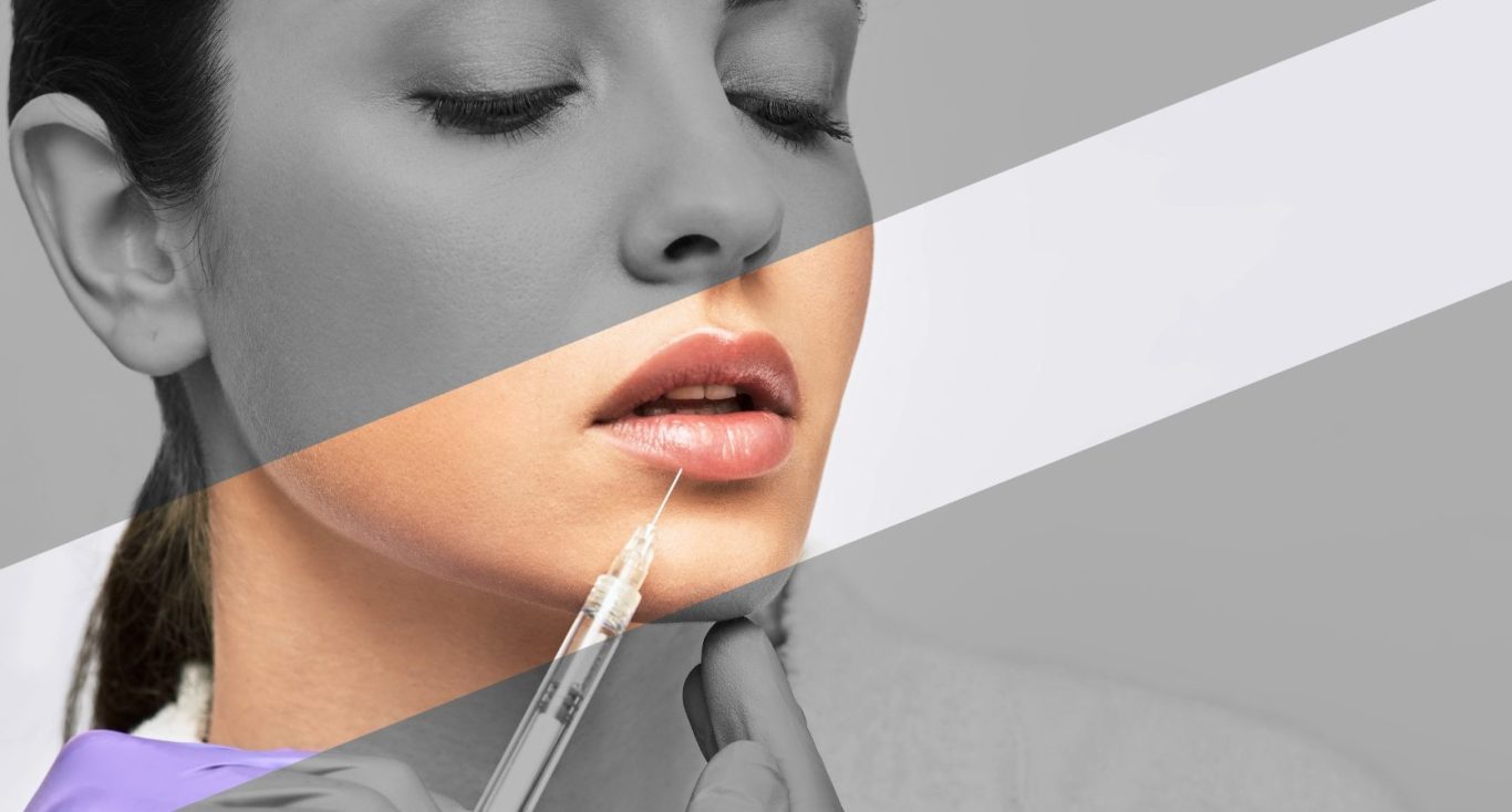 Hyaluron Behandlung bei AMF Aesthetic Medical Fusion in Reutlingen