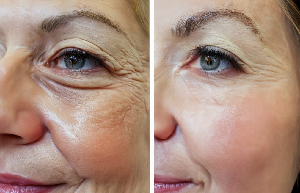 Vorher-Nachher Anti-Aging Behandlung bei  AMF Aesthetic Medical Fusion in Reutlingen