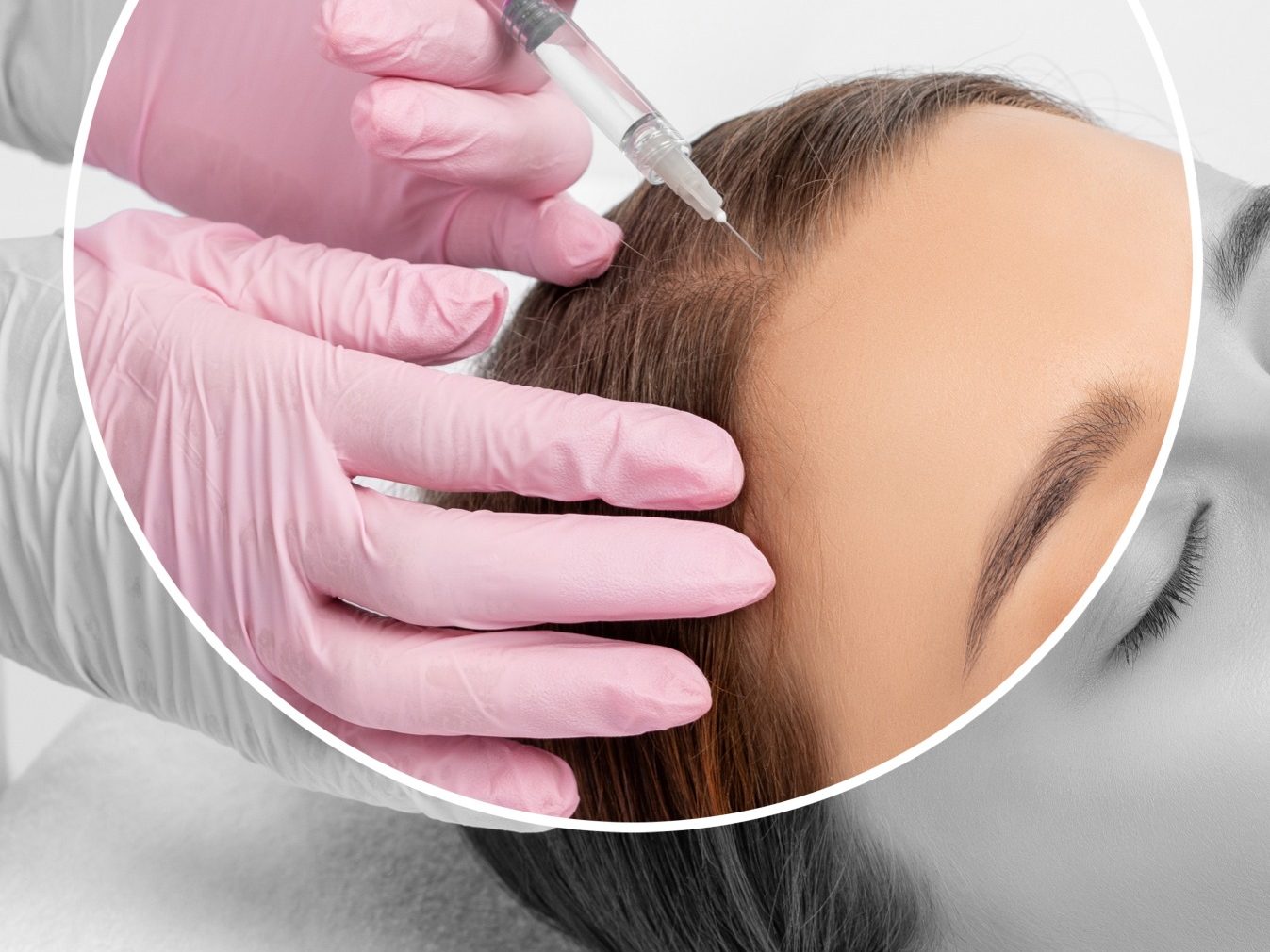Meso Hair Behandlung bei AMF Aesthetic Medical Fusion in Reutlingen