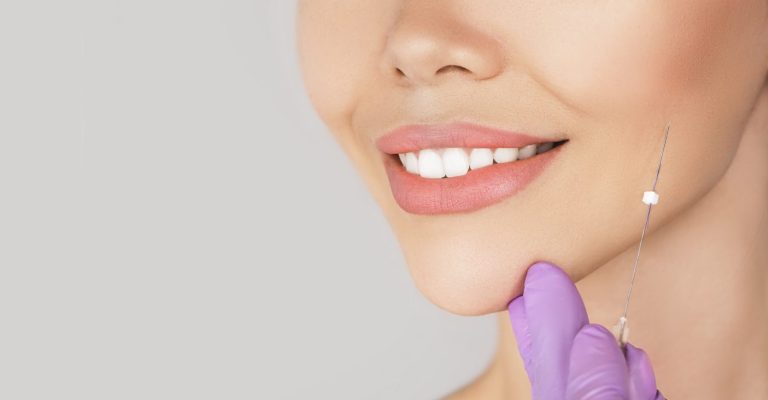 Fadenlifting Zugfäden Behandlung bei AMF Aesthetic Medical Fusion in Reutlingen