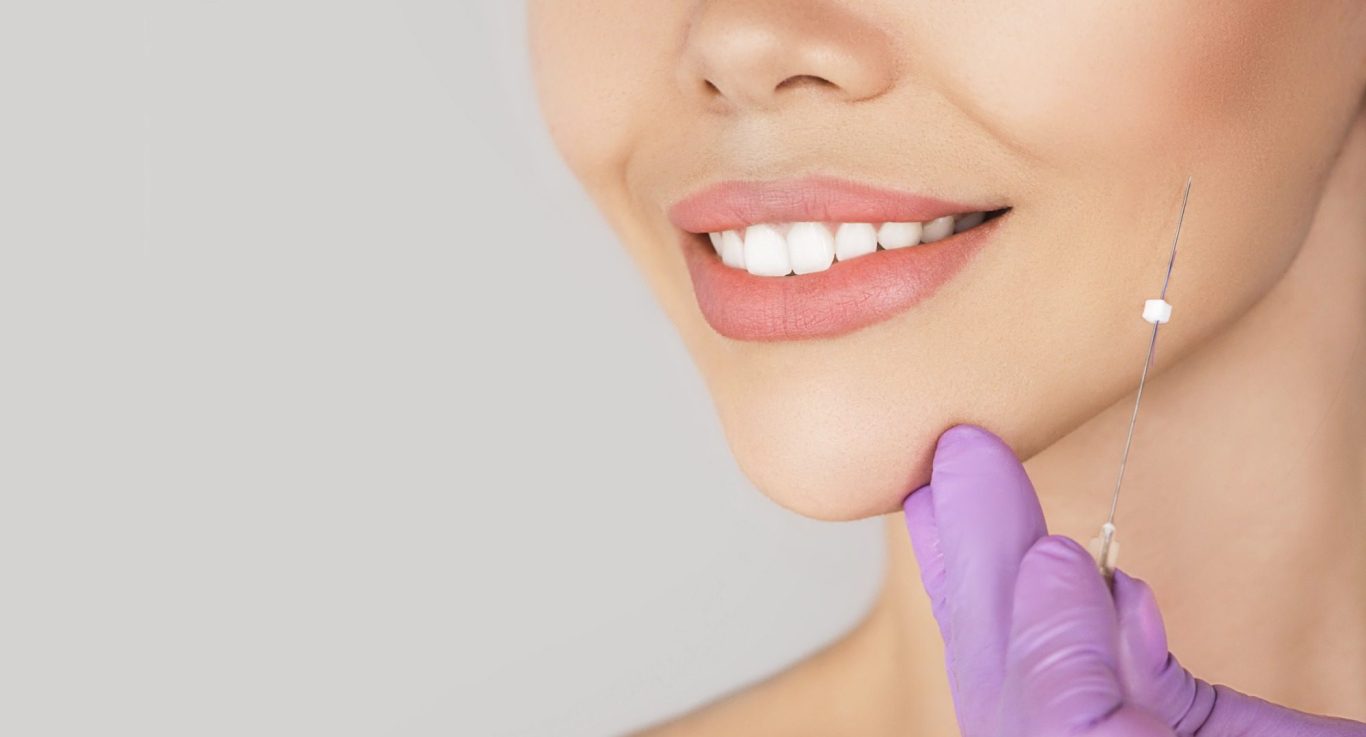 Fadenlifting Behandlung bei AMF Aesthetic Medical Fusion in Reutlingen