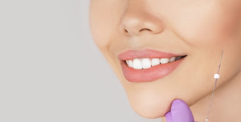 Fadenlifting glatte Fäden Behandlung bei AMF Aesthetic Medical Fusion in Reutlingen